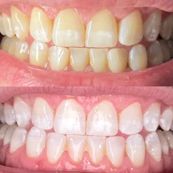 Before and after comparison