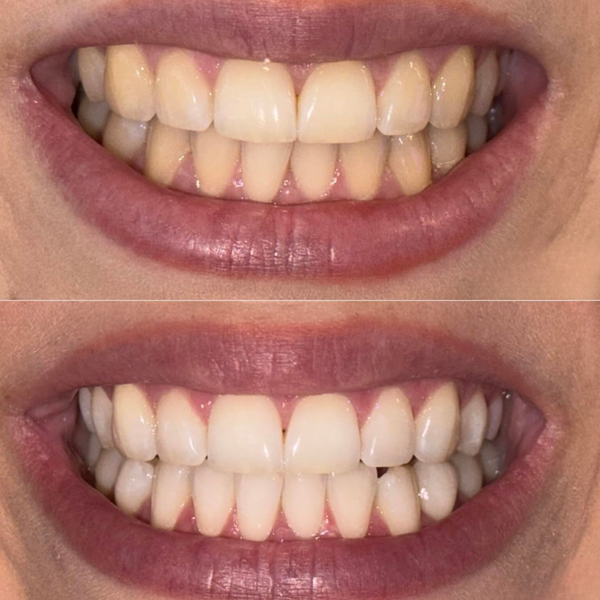 Before and after comparison