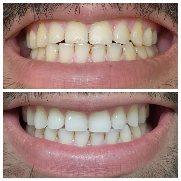 Before and after comparison